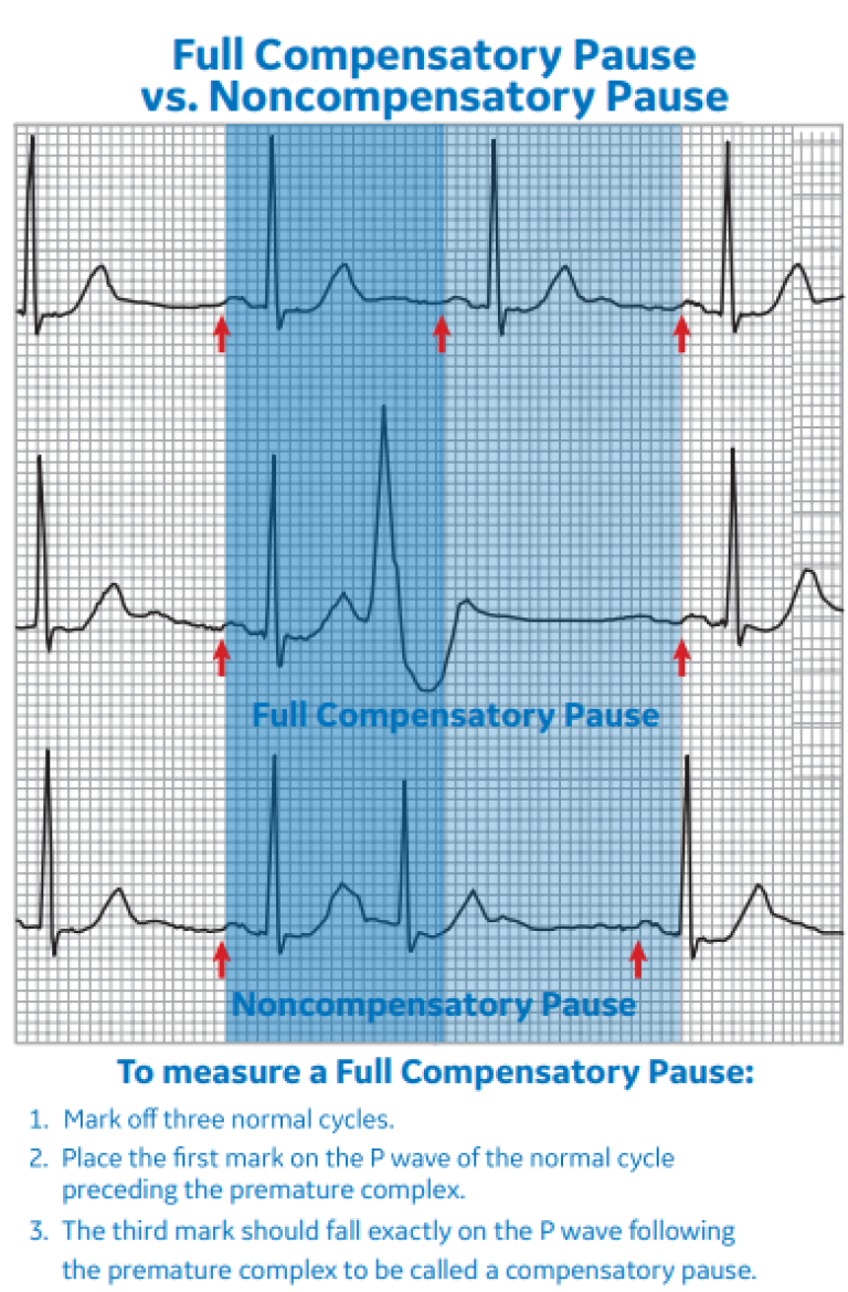 arrhythmia-recognition-part-2-clinical-view